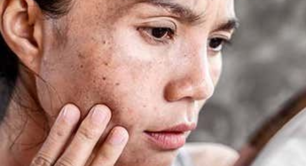 laser for pigmentation