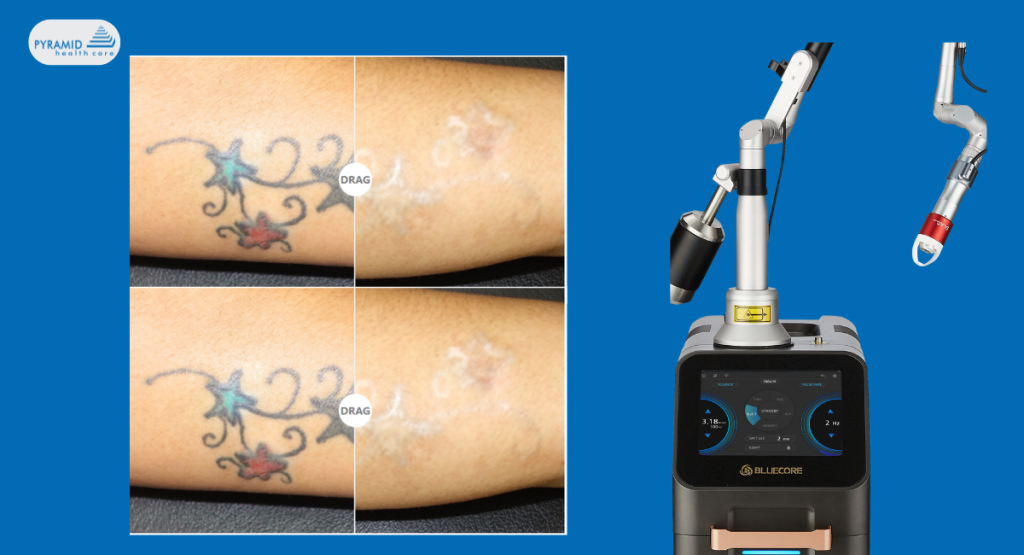 Tattoo Removal Machine