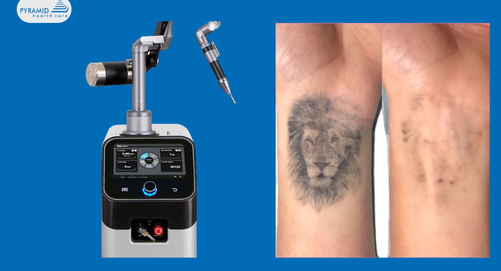 laser tattoo removal machine