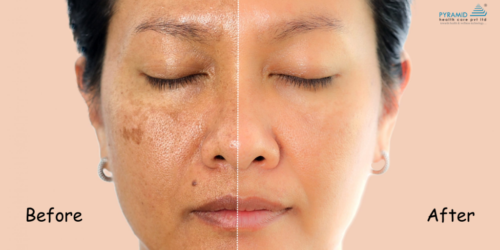 Laser for Pigmentation