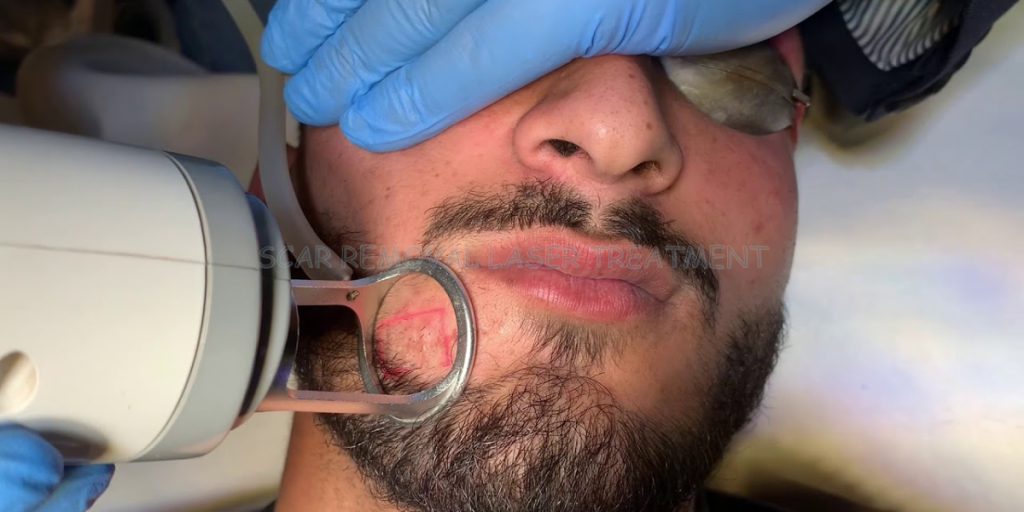 Scar Removal Laser Treatment