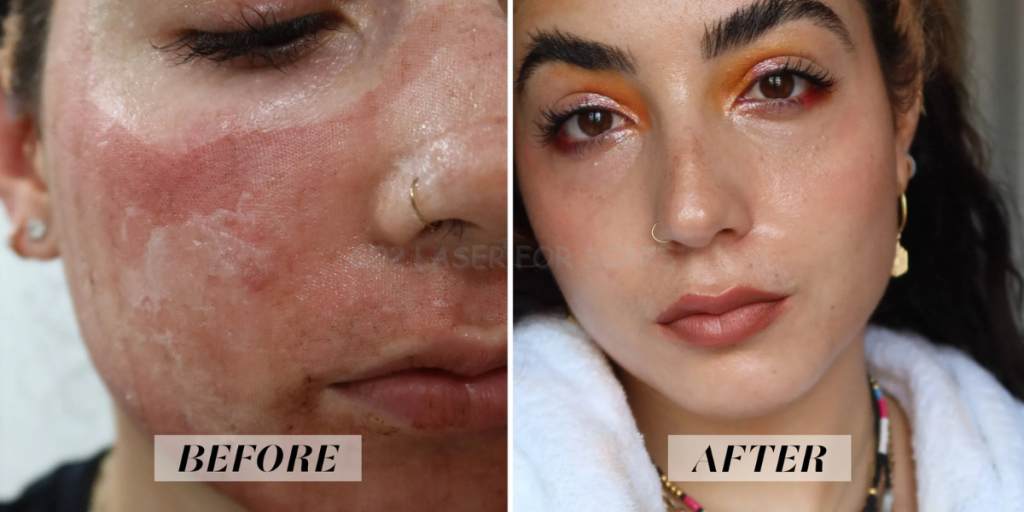 co2 laser for scars