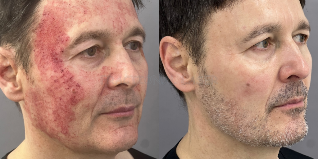 fractional laser