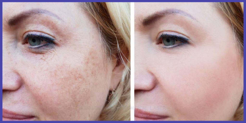 pigmentation removal laser
