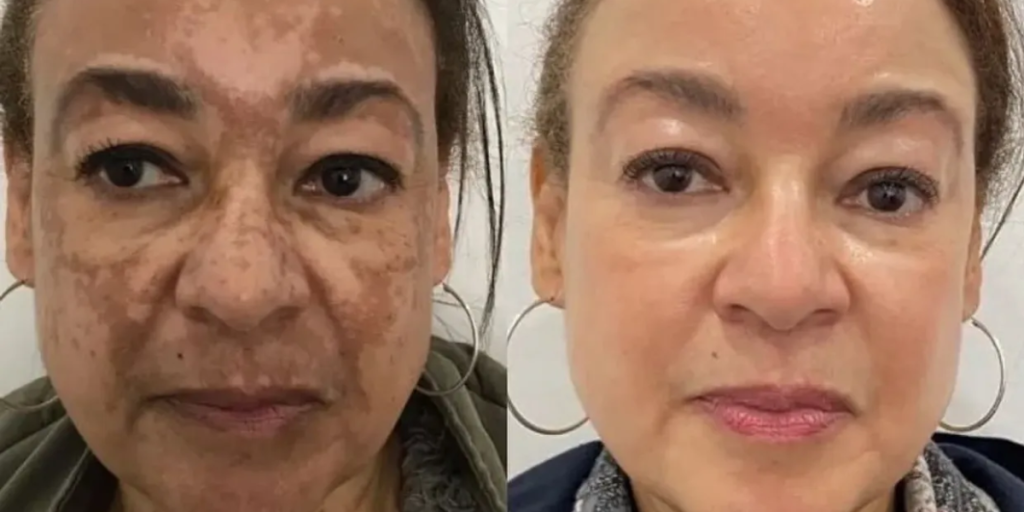Chemical Peel for Pigmentation
