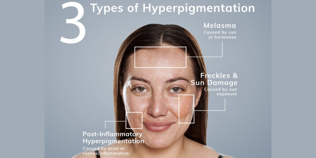 best treatment for melasma on face