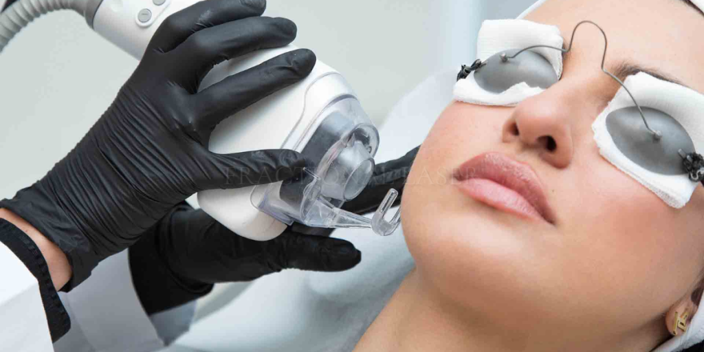 fractional laser