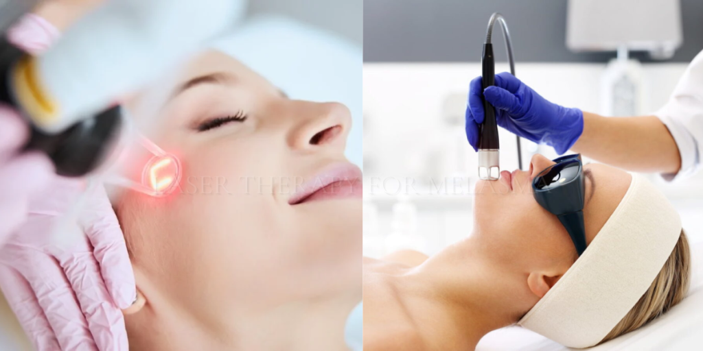 laser therapy for melasma
