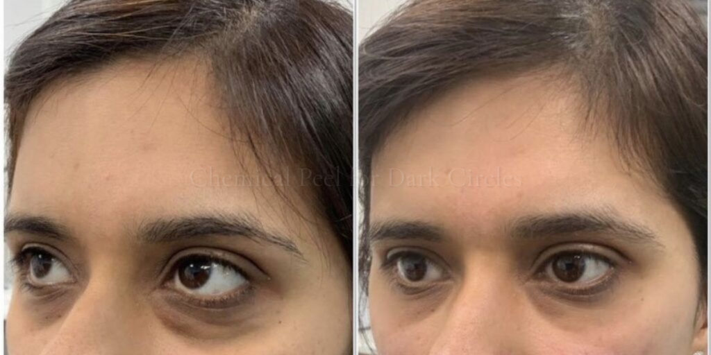 Chemical Peel for Dark Circles