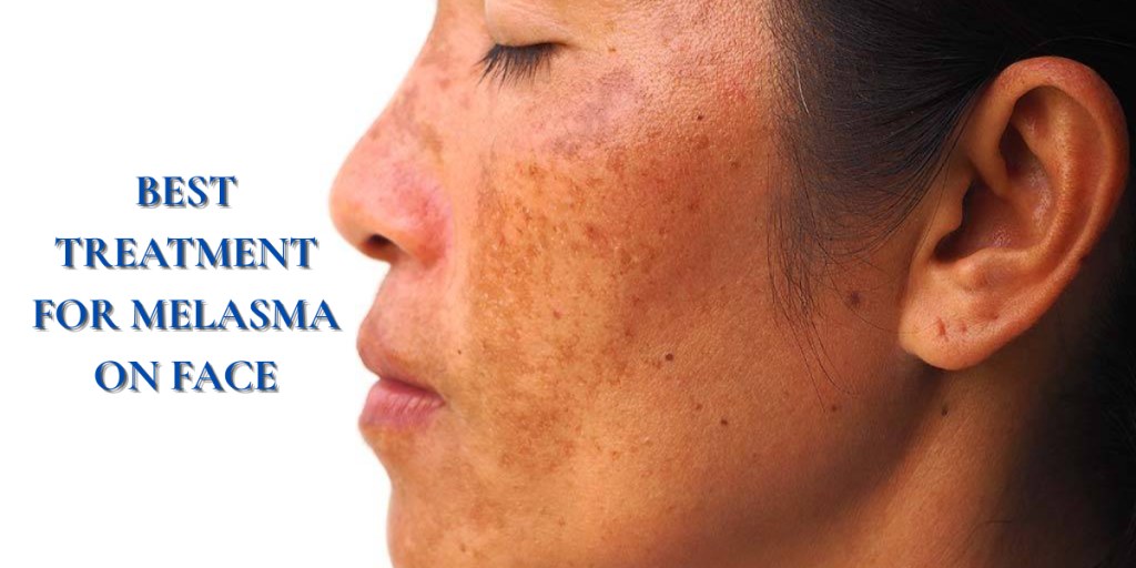 best treatment for melasma on face