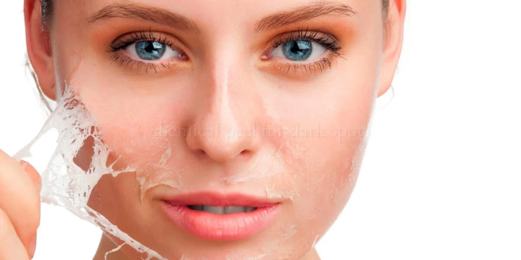 chemical peel for dark spots