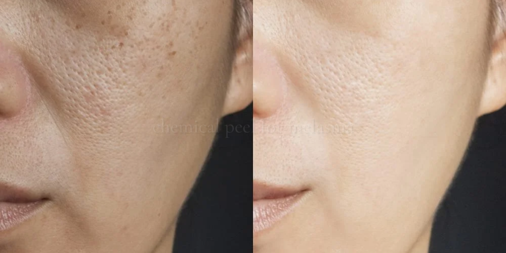 chemical peel for melasma