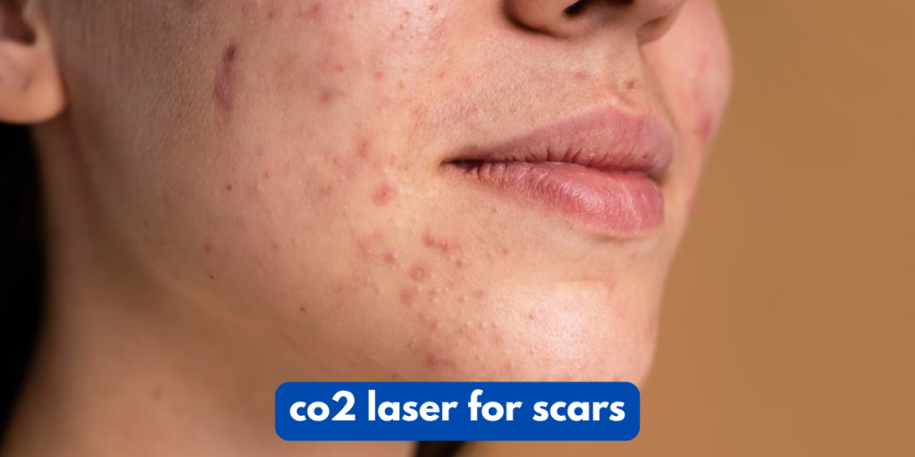 co2 laser for scars