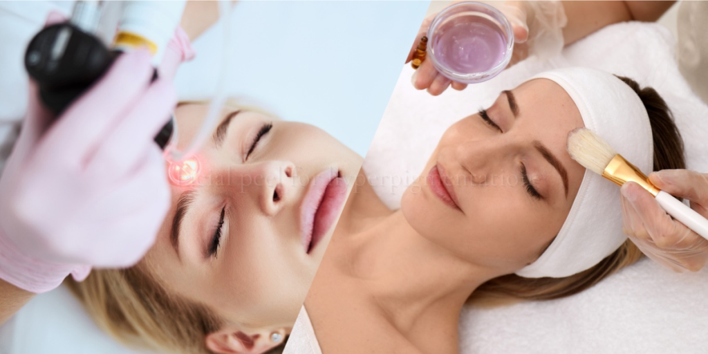 facial peel for hyperpigmentation