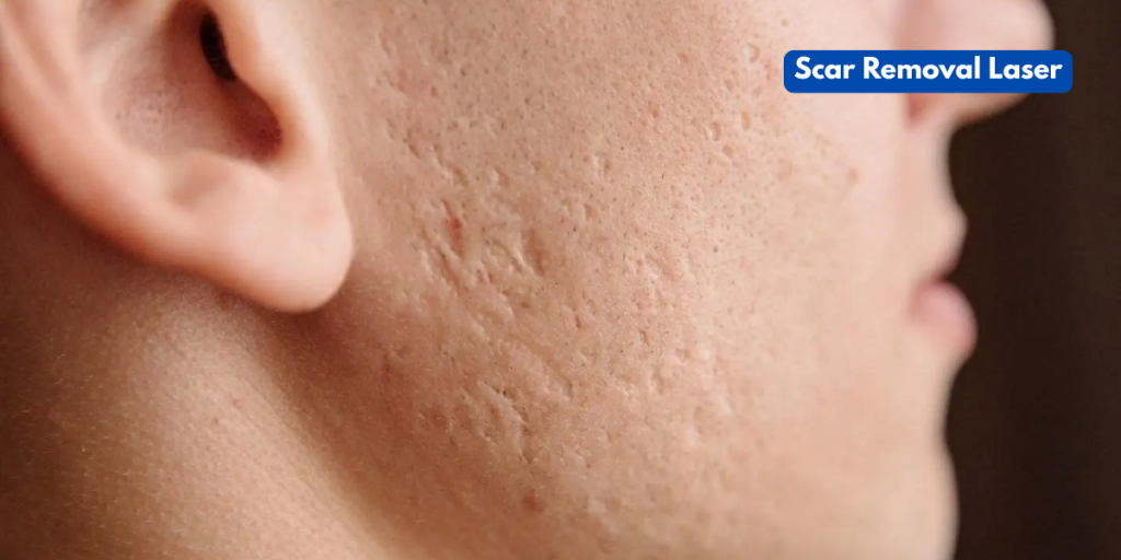 Scar Removal Laser