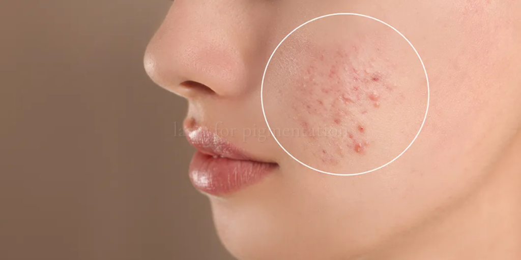 laser for pigmentation