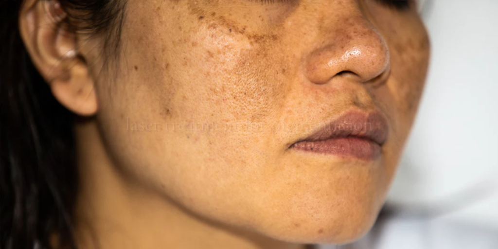 laser treatment for pigmentation