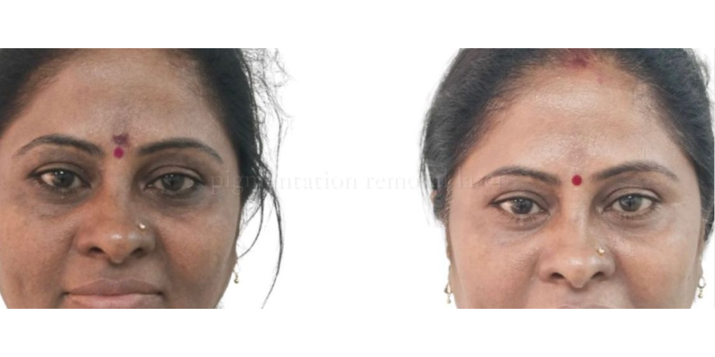 pigmentation removal laser