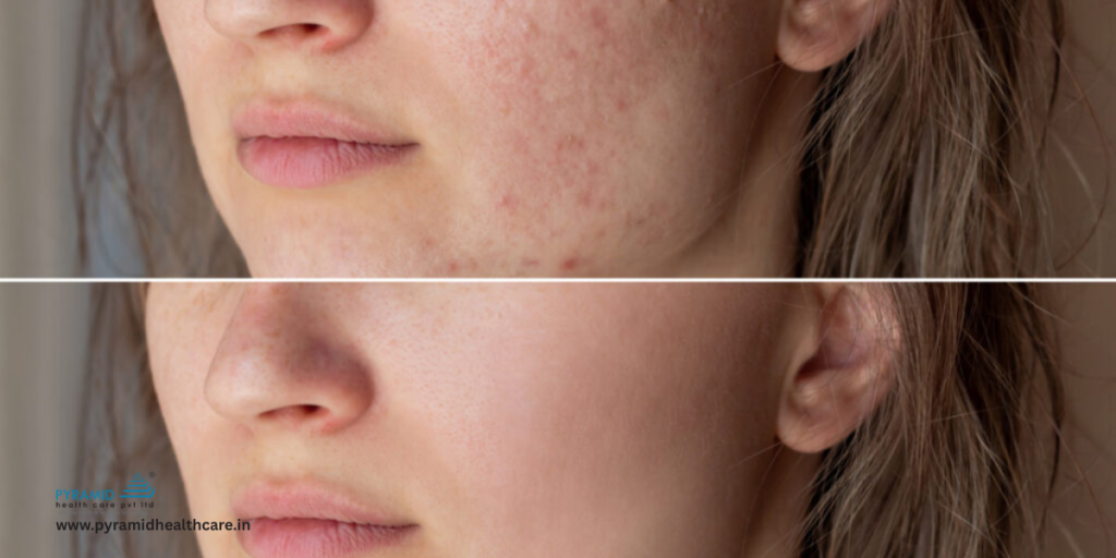 chemical peel for dark sports