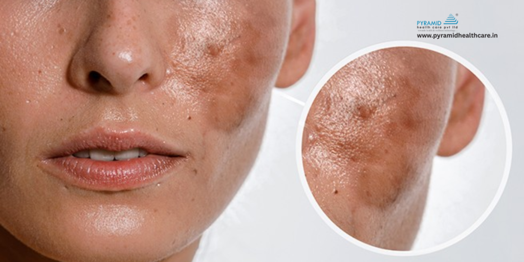 chemical peel for melasma