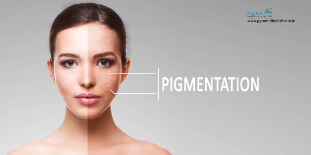pigmentation removal laser