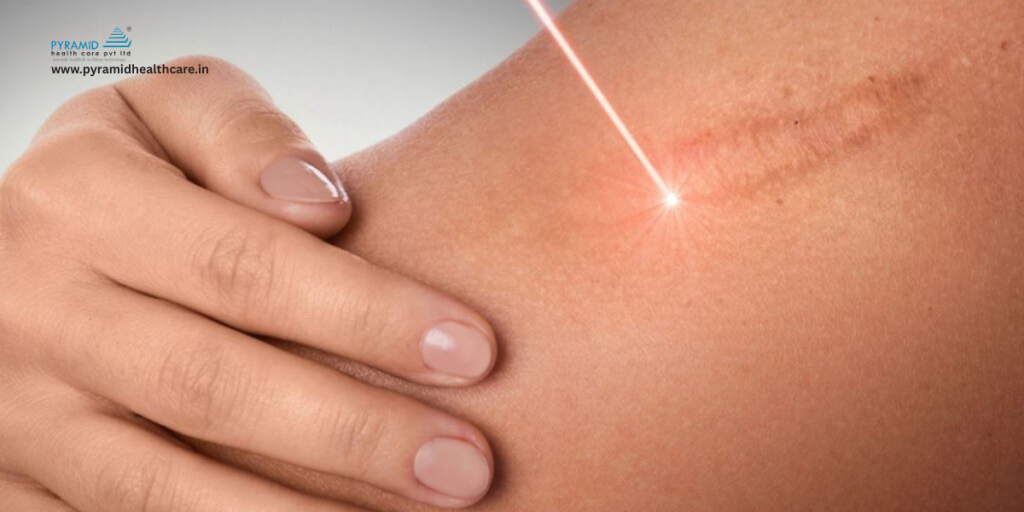 scar removal laser