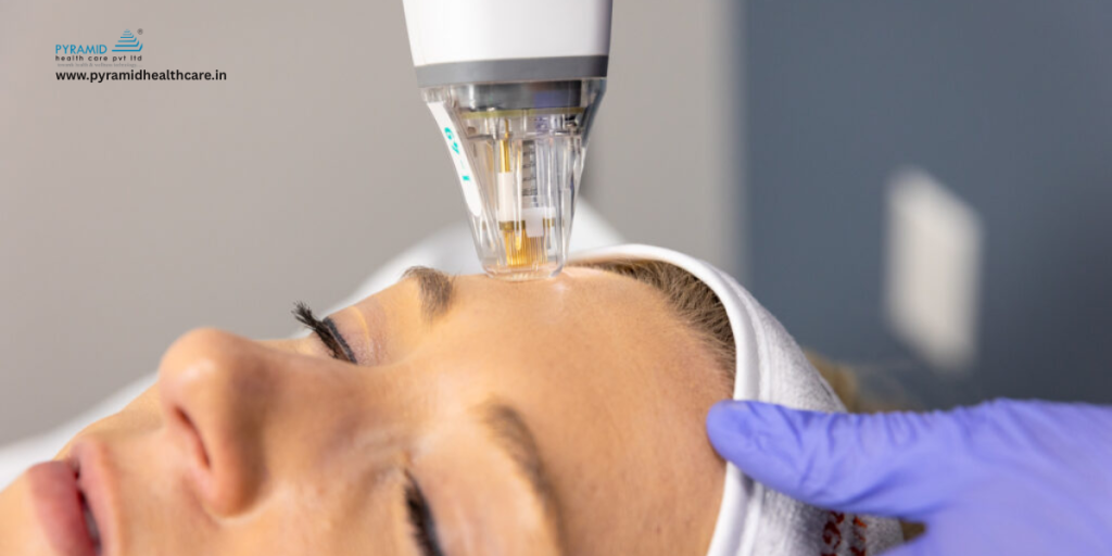 stretch mark removal machine