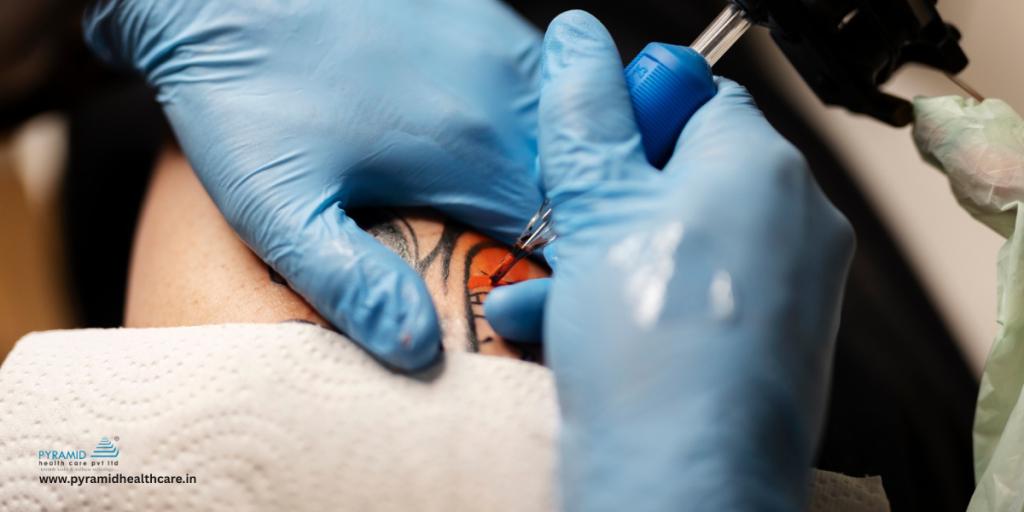 tattoo removal machine laser