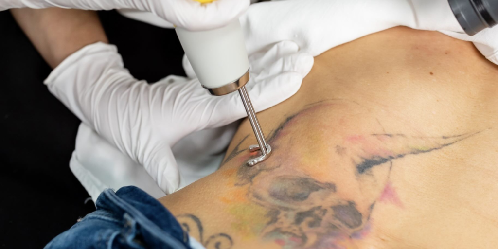 tattoo removal machine price