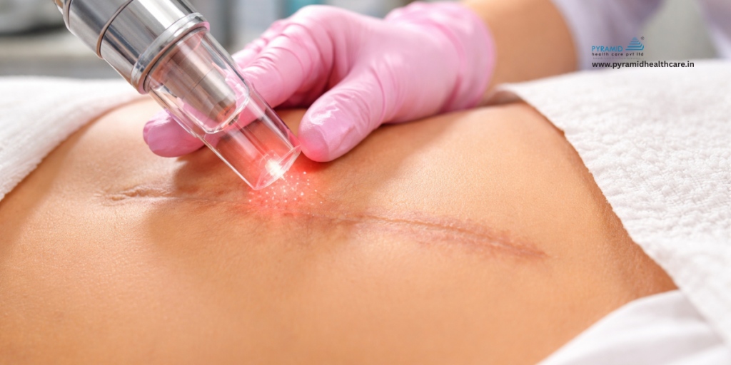CO2 laser for surgical scars
